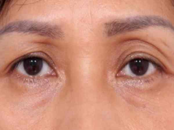 Mắt sâu là gì? Đặc điểm nhận biết Mắt sâu là gì? Đặc điểm nhận biết