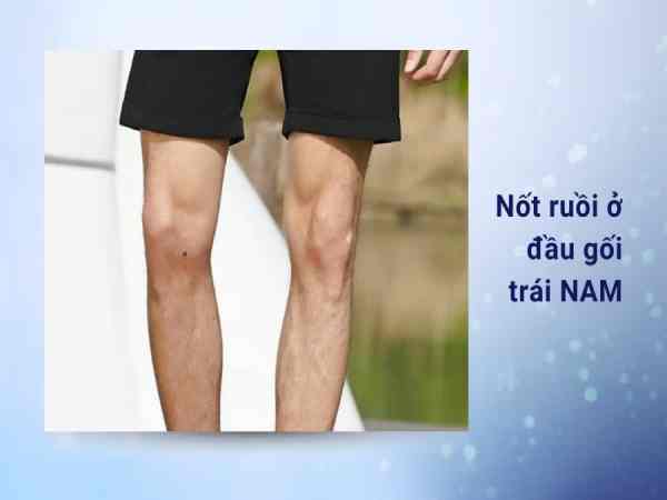nốt ruồi đầu gối