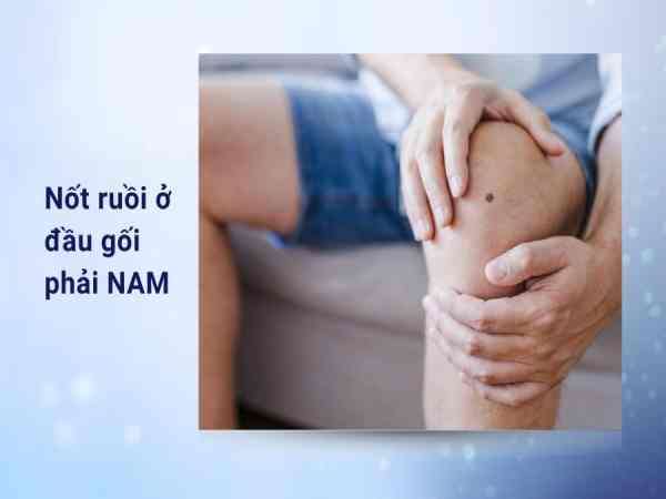 Nốt ruồi ở đầu gối phải nam giới: