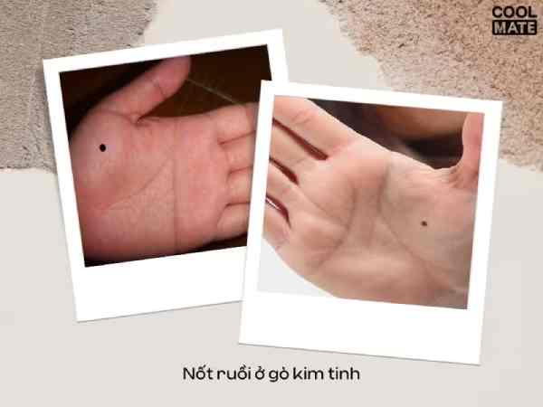 nốt ruồi ở gò kim tinh