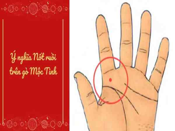 nốt ruồi ở gò mộc tinh