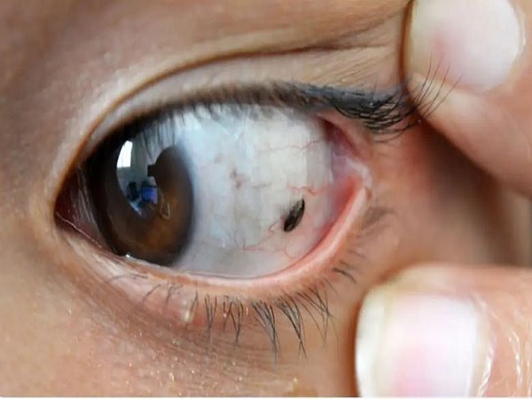 Mụn ruồi trong mắt trái có ý nghĩa gì trong nhân tướng học